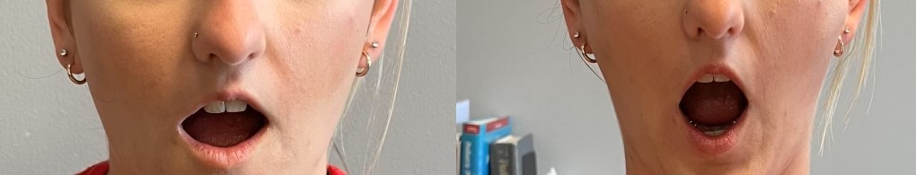 Stark Performance Physical Therapy Pensacola TMJ Dysfunction Rehabilitation Dry Needling Stark Performance Physical Therapy Pensacola TMJ Dysfunction Rehabilitation Dry Needling